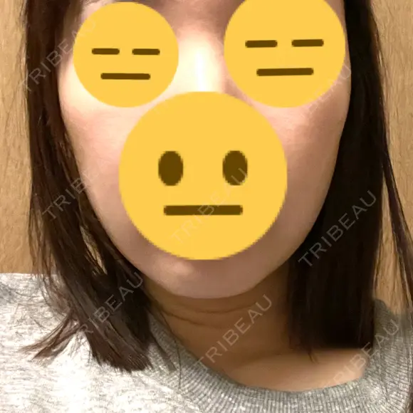 RF（高周波）たるみ治療 MEMOTO CLINIC 名古屋 DAY 6 メイン用