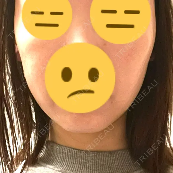 RF（高周波）たるみ治療 MEMOTO CLINIC 名古屋 DAY 7 メイン用