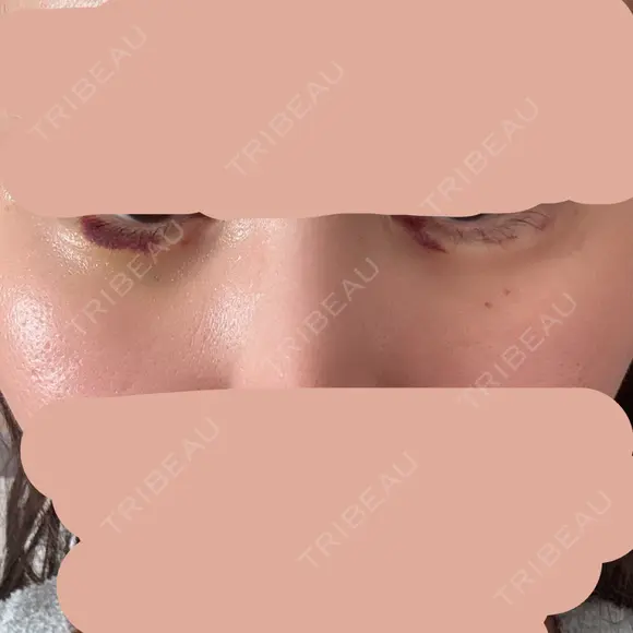 ヒアルロン酸注入（涙袋） / ヒアルロン酸注入（唇） PRO CLINIC プロクリニック 銀座院 DAY 7 メイン用