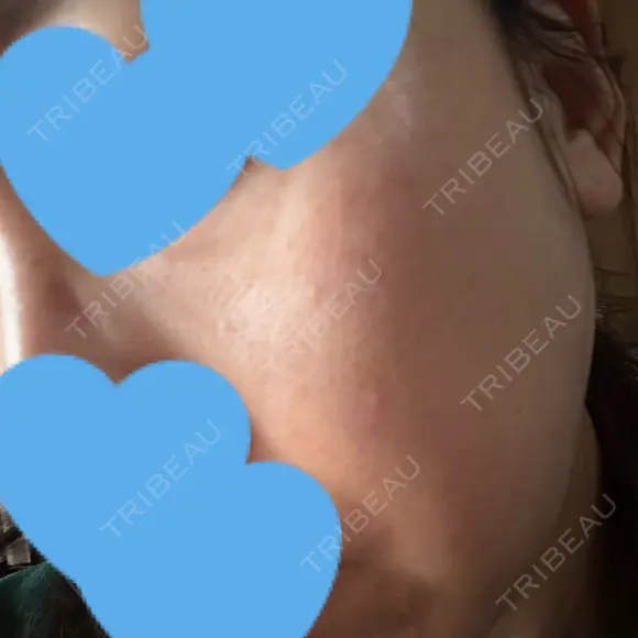 リジュラン ミニマムスキンクリニック池袋 DAY 8 メイン用