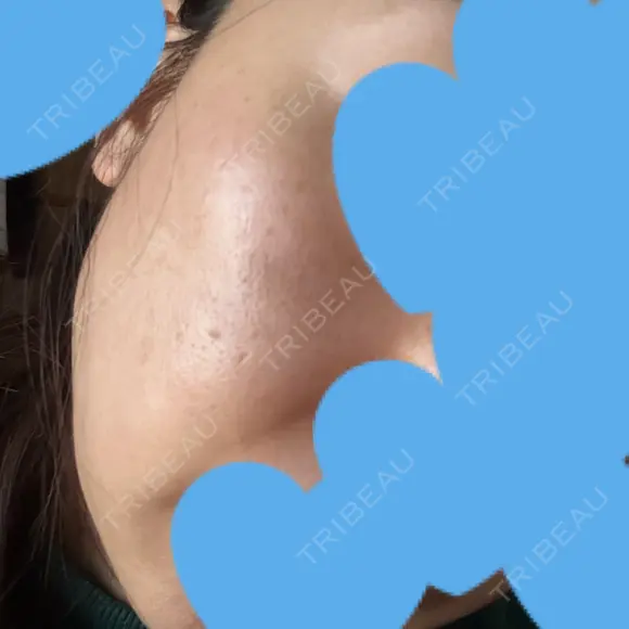 リジュラン ミニマムスキンクリニック池袋 DAY 8 メイン用