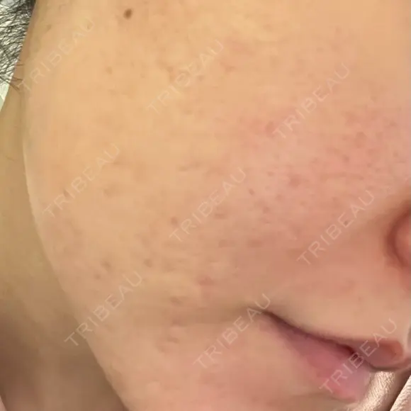 肌育注射（ジュベルックなど） / その他（肌） 大美会クリニック 京都烏丸院 AFTER メイン用