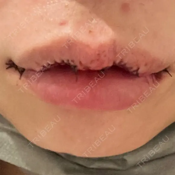 口角挙上 / その他（口元） アネシス美容クリニック DAY 0 メイン用