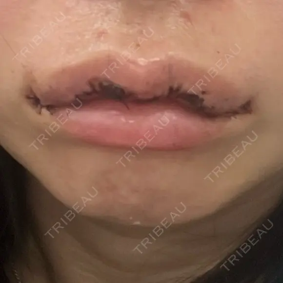 口角挙上 / その他（口元） アネシス美容クリニック DAY 1 メイン用