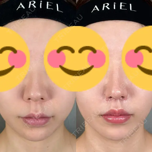 鼻尖形成（切開） / 人中短縮 / 鼻孔縁挙上 / その他（鼻） アリエル美容クリニック 大宮院 DAY 94 メイン用