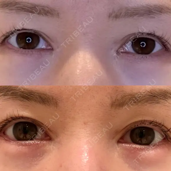 目尻切開 / タレ目形成・グラマラスライン（埋没） LOUIS CLINIC 二子玉川院【ルイクリニック】 DAY 10 メイン用