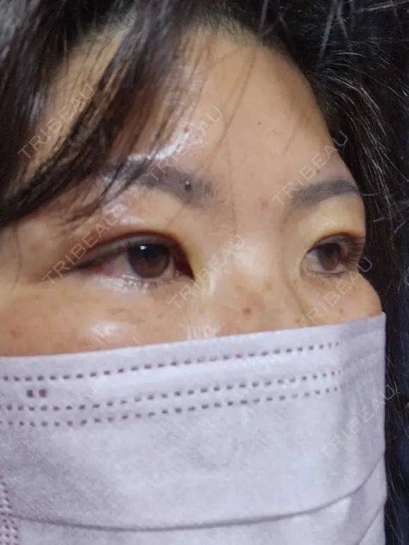 二重埋没 湘南美容クリニック 千葉センシティ院 DAY 5 メイン用