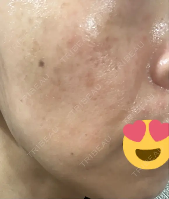 ルメッカ ルラ美容クリニック 札幌本院 AFTER メイン用