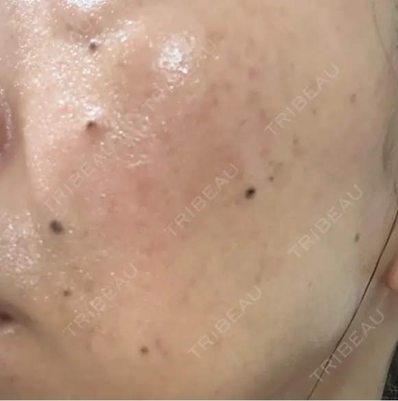 ルメッカ ルラ美容クリニック 札幌本院 DAY 3 メイン用