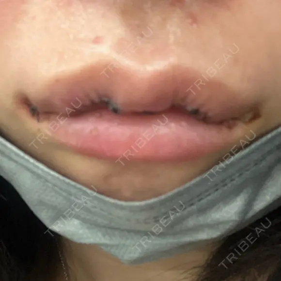 口角挙上 / その他（口元） アネシス美容クリニック DAY 2 メイン用