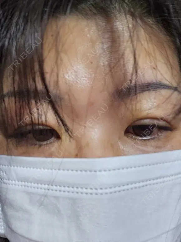 二重埋没 湘南美容クリニック 千葉センシティ院 DAY 6 メイン用