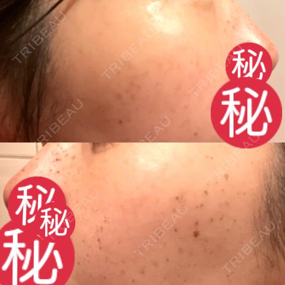 ルメッカ MIO CLINIC 梅田院 DAY 10 メイン用