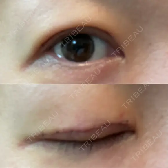 二重切開 / 上まぶたたるみ取り / 上まぶたの脂肪取り VIDA BEAUTY CLINIC DAY 5 メイン用