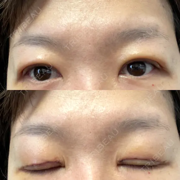 二重切開 / 上まぶたたるみ取り / 上まぶたの脂肪取り VIDA BEAUTY CLINIC DAY 6 メイン用
