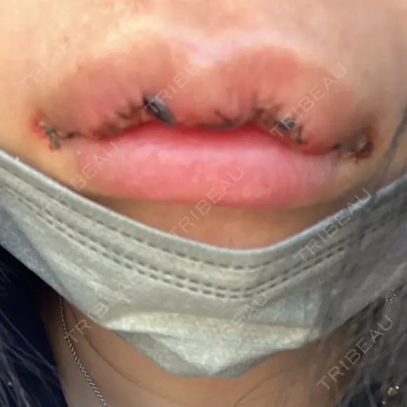 口角挙上 / その他（口元） アネシス美容クリニック DAY 3 メイン用