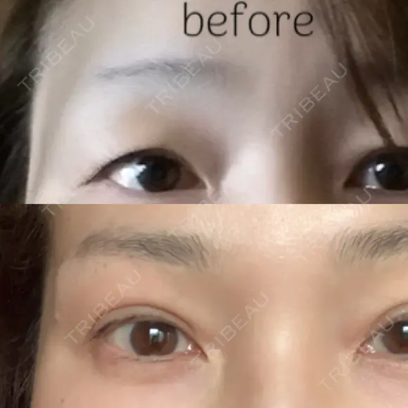 眉下切開 湘南美容クリニック 秋葉原院 DAY 1761 メイン用