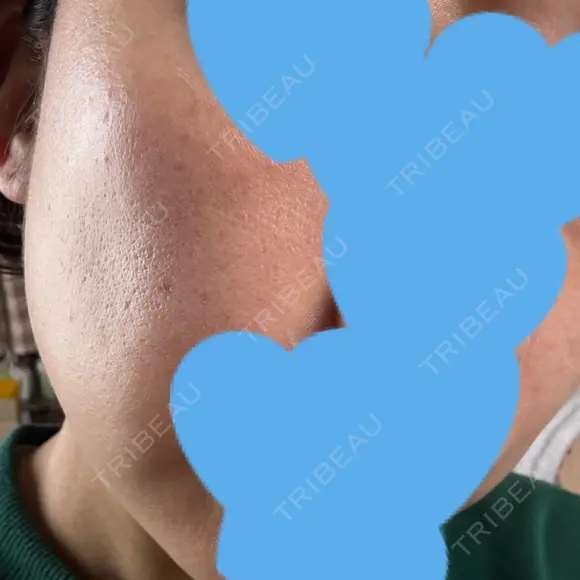 リジュラン ミニマムスキンクリニック池袋 DAY 9 メイン用