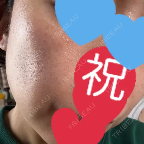 リジュラン ミニマムスキンクリニック池袋 DAY 10 メイン用