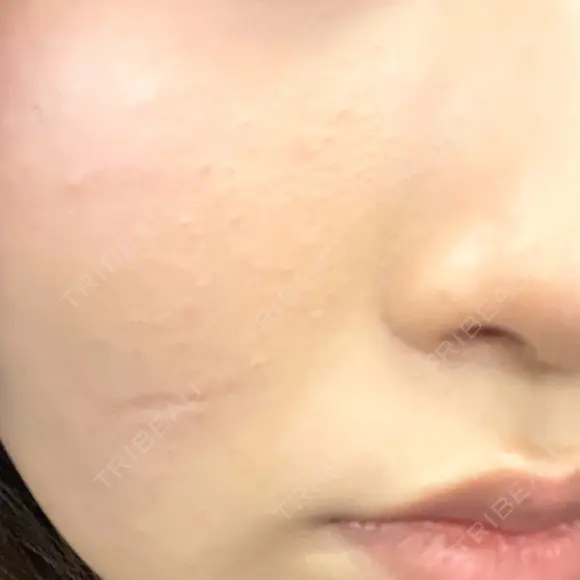 ポテンツァ 上野美容外科・美容皮膚科 DAY 1 メイン用