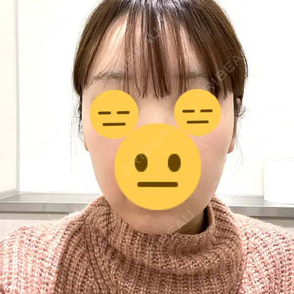 RF（高周波）たるみ治療 MEMOTO CLINIC 名古屋 DAY 11 メイン用