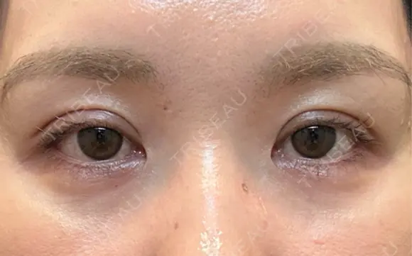 自然癒着法 銀座リシェスクリニック AFTER メイン用