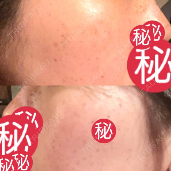 ルメッカ MIO CLINIC 梅田院 DAY 9 メイン用