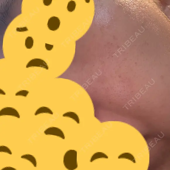 リジュラン ミニマムスキンクリニック池袋 DAY 11 メイン用