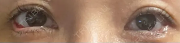 目尻切開 / タレ目形成・グラマラスライン（埋没） LOUIS CLINIC 二子玉川院【ルイクリニック】 DAY 7 メイン用