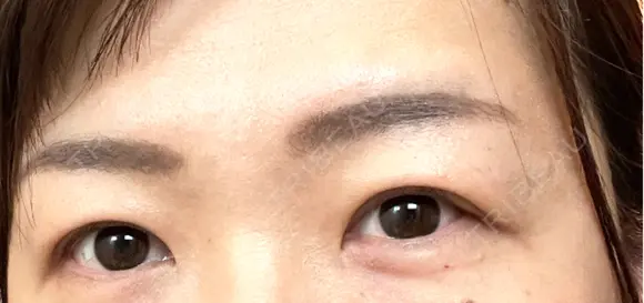 二重切開 / 上まぶたたるみ取り / 上まぶたの脂肪取り VIDA BEAUTY CLINIC DAY 7 メイン用