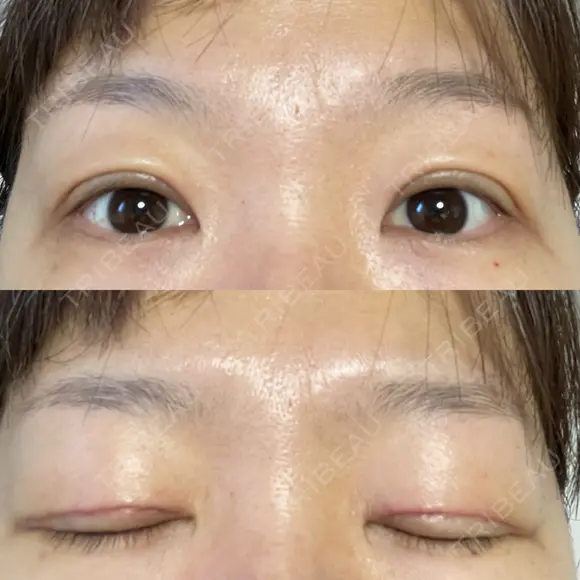 二重切開 / 上まぶたたるみ取り / 上まぶたの脂肪取り VIDA BEAUTY CLINIC DAY 8 メイン用