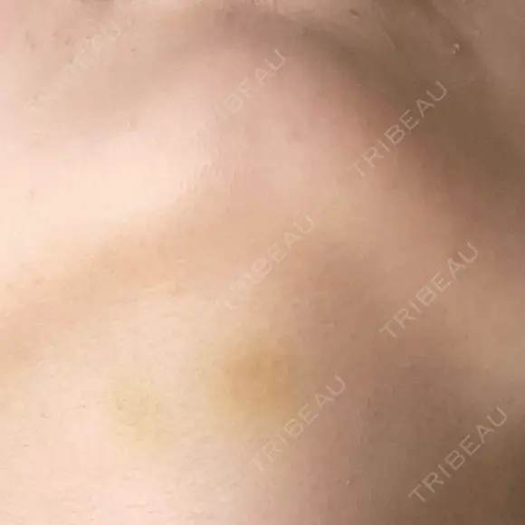 脂肪溶解注射（顔） / ルメッカ ブルームクリニック（BLOOM CLINIC） DAY 8 メイン用