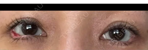 目尻切開 / タレ目形成・グラマラスライン（埋没） LOUIS CLINIC 二子玉川院【ルイクリニック】 DAY 8 メイン用