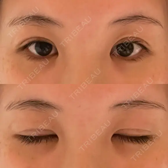 二重切開 / 眼瞼下垂（切開） / 上まぶたたるみ取り ユア美容クリニック 福岡院 DAY 12 メイン用