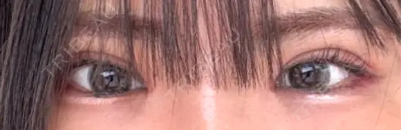 二重切開 / 眼瞼下垂（切開） オーキッド美容クリニック東京御徒町 AFTER メイン用