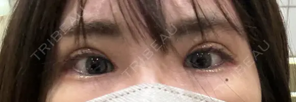 二重切開 / 眼瞼下垂（切開） オーキッド美容クリニック東京御徒町 DAY 74 メイン用