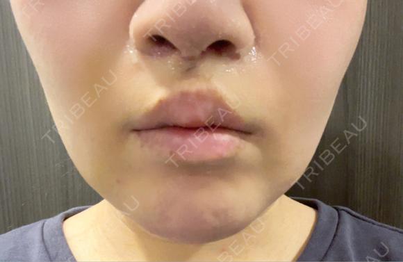その他（鼻） / 人中短縮 / 鼻柱下降・鼻唇角形成（猫手術） Otus Clinic 【オータスクリニック】 DAY 7 メイン用