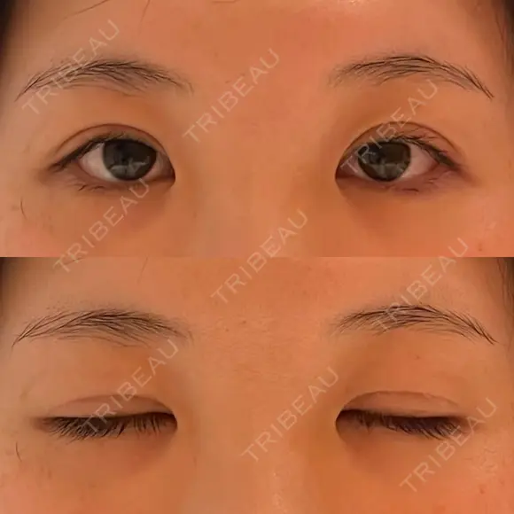 二重切開 / 眼瞼下垂（切開） / 上まぶたたるみ取り ユア美容クリニック 福岡院 DAY 13 メイン用