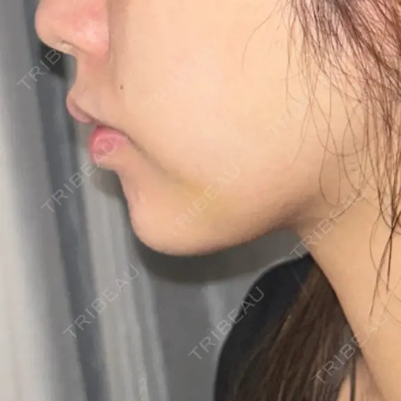 ボトックス（額） ルラ美容クリニック銀座院 AFTER メイン用