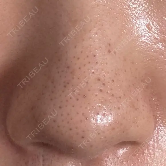 アグネス 日本美容・医療クリニック 六本木院 DAY 8 メイン用