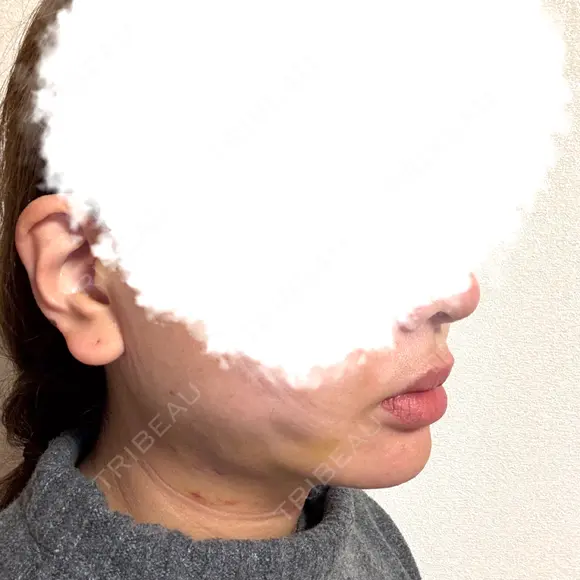 糸リフト / 脂肪吸引（顔） EMMA CLINIC（エマクリニック） DAY 14 メイン用