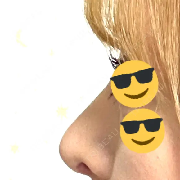 鼻尖形成（切開） / 軟骨移植 / 骨切幅寄せ / プロテーゼ除去 9BeautyClinic AFTER メイン用
