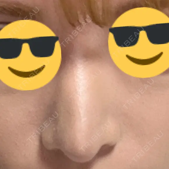 鼻尖形成（切開） / 軟骨移植 / 骨切幅寄せ / プロテーゼ除去 9BeautyClinic DAY 87 メイン用