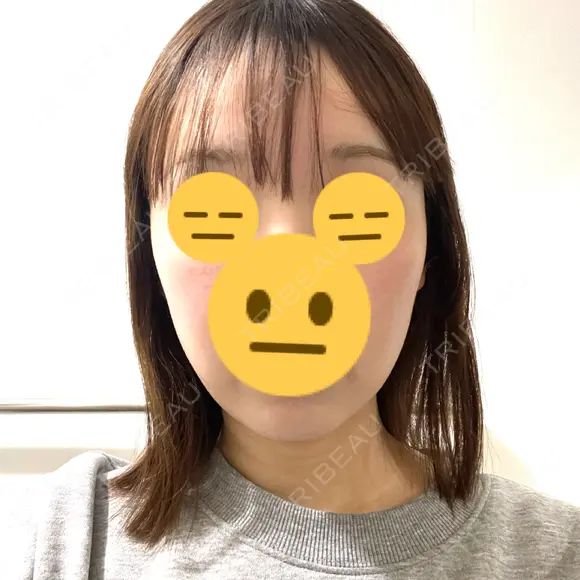 RF（高周波）たるみ治療 MEMOTO CLINIC 名古屋 DAY 14 メイン用