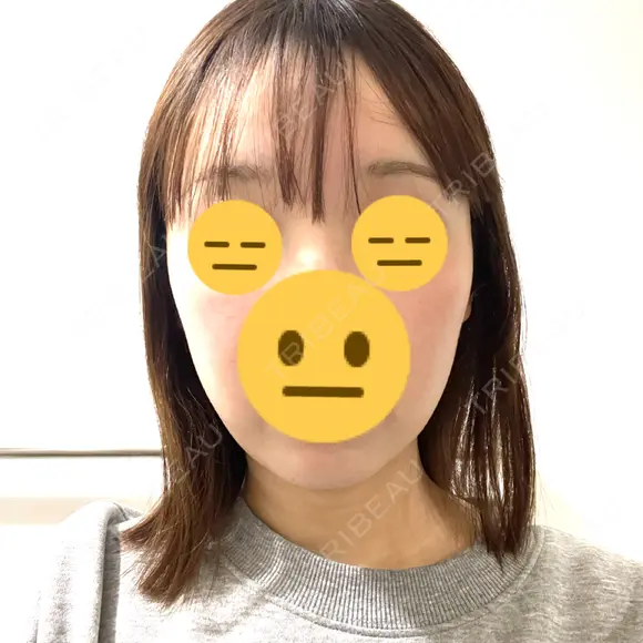 脂肪吸引注射（顔） ルラ美容クリニック 名古屋栄院 / ルラスキンクリニック 名古屋栄院 DAY 8 メイン用
