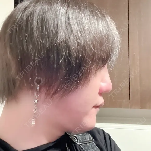 二重切開 / 目頭切開 / 眼瞼下垂（切開） / 隆鼻術 / 鼻中隔延長（切開） / 小鼻縮小（切開） / 骨切幅寄せ id（アイディ）美容外科 DAY 366 メイン用
