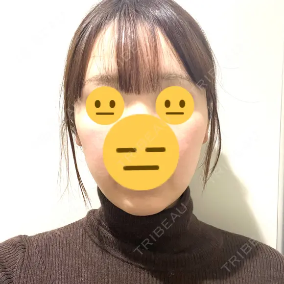 脂肪吸引注射（顔） ルラ美容クリニック 名古屋栄院 / ルラスキンクリニック 名古屋栄院 DAY 9 メイン用