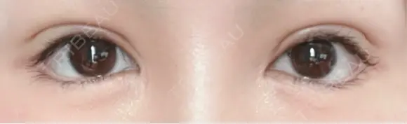 二重切開 / 眼瞼下垂（切開） ユア美容クリニック 福岡院 DAY 8 メイン用