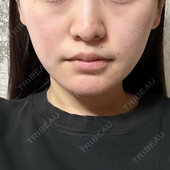 糸リフト / 脂肪吸引（顔） / ボトックス（エラ・小顔） HAAB×DREAM BEAUTY CLINIC 東京本院 DAY 79 メイン用