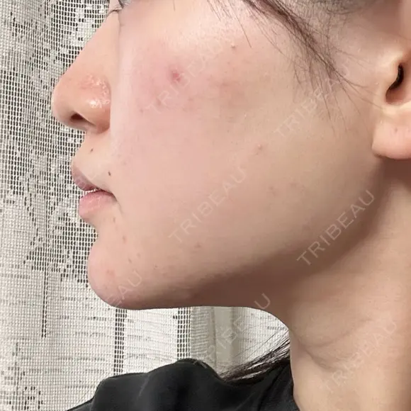 糸リフト / 脂肪吸引（顔） / ボトックス（エラ・小顔） HAAB×DREAM BEAUTY CLINIC 東京本院 DAY 79 メイン用