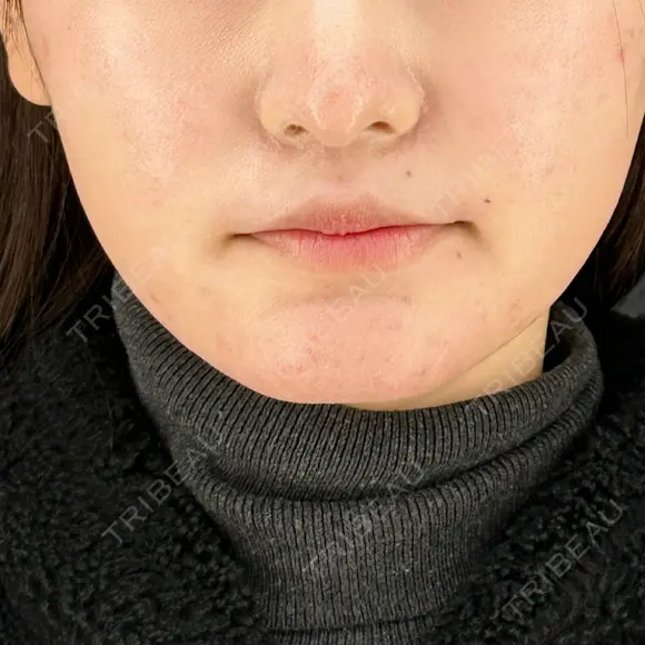 糸リフト / 脂肪吸引（顔） / ボトックス（エラ・小顔） HAAB×DREAM BEAUTY CLINIC 東京本院 AFTER メイン用
